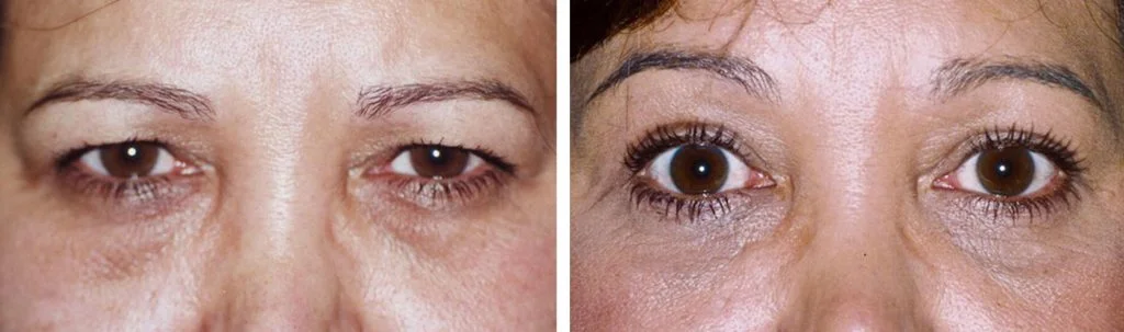brow-lift-before-and-after-4-1-1024x303