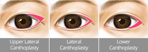 canthoplasty