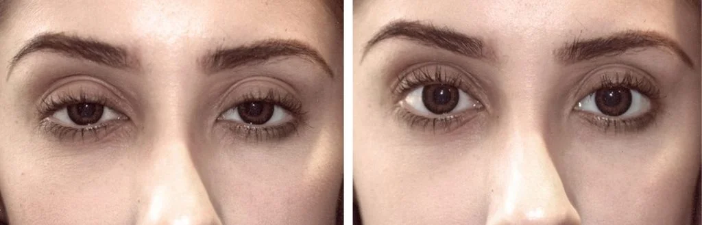 eye-lift-before-after-1-1024x329