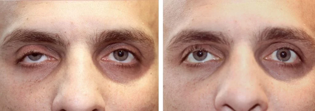 eye-lift-before-after-10-1024x362