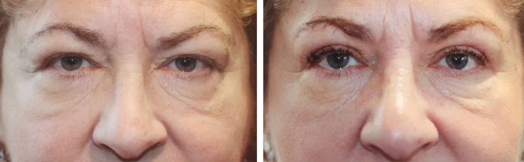 eye-lift-before-after-3-1024x317