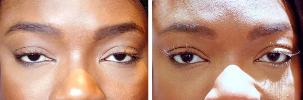 eye-lift-before-after-4-1024x340