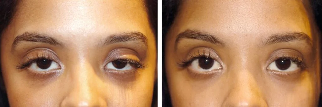 eye-lift-before-after-7-1024x340