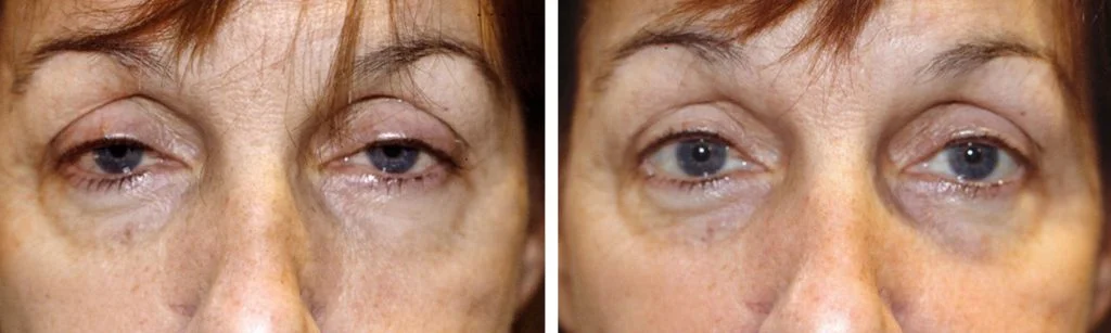eye-lift-before-after-8-1024x307