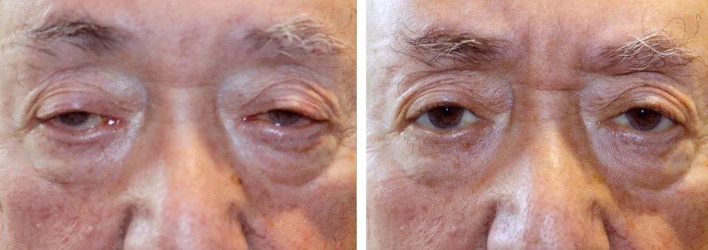 eye-lift-before-after-9-1-1024x362