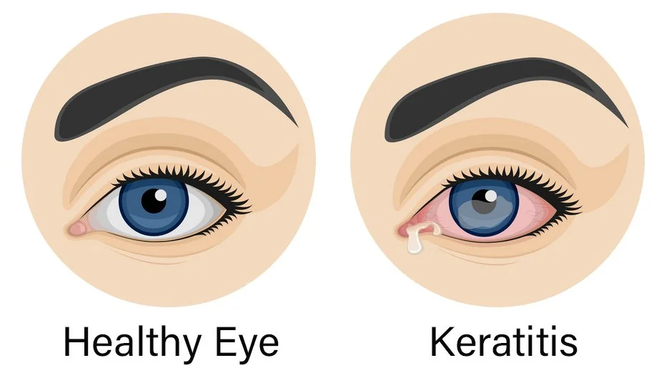 keratitis