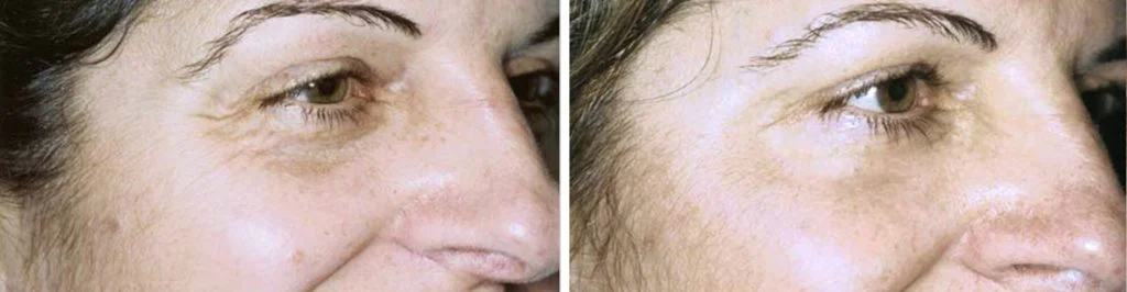 laser-skin-resurfacing-before-after-1-1024x266