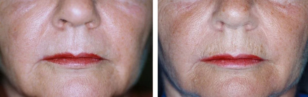 laser-skin-resurfacing-before-after-10-1024x325