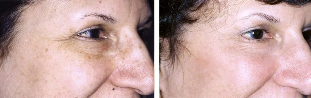 laser-skin-resurfacing-before-after-11-1024x325