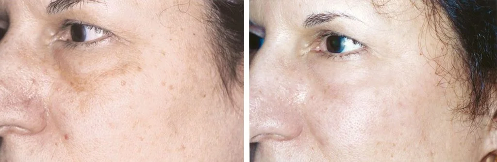 laser-skin-resurfacing-before-after-3-1024x335