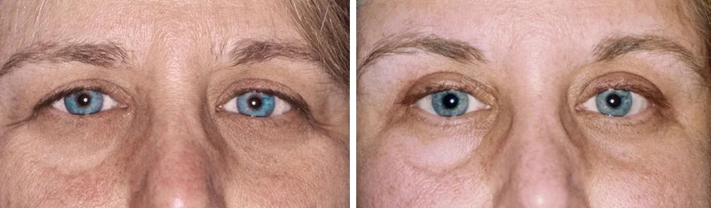 laser-skin-resurfacing-before-after-6-1024x300