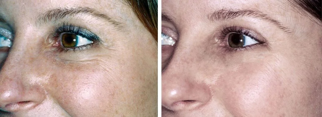 laser-skin-resurfacing-before-after-7-1024x373
