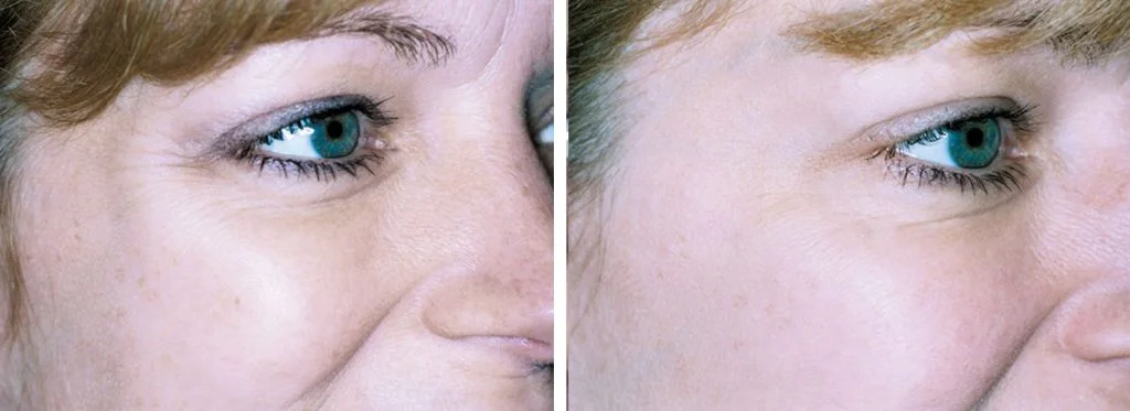 laser-skin-resurfacing-before-after-8-1024x373