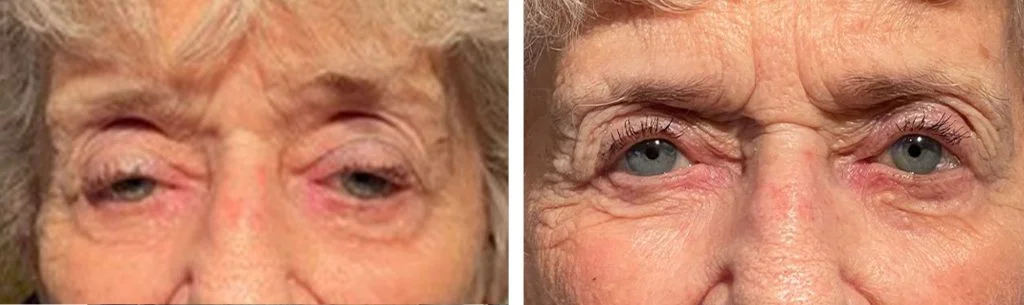 ptosis-before-after-1-1024x305