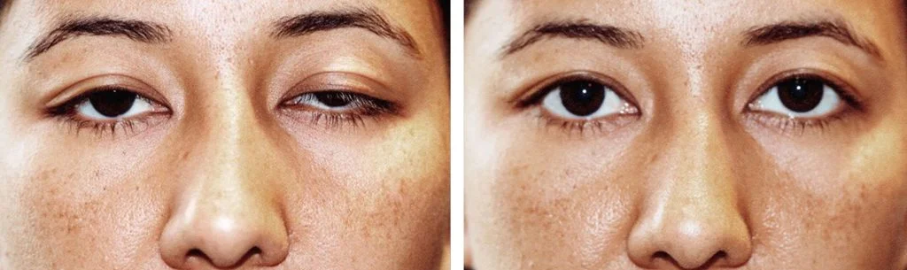 ptosis-before-after-10-1024x305