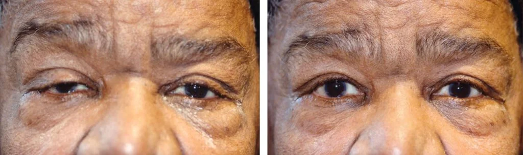 ptosis-before-after-11-1024x305