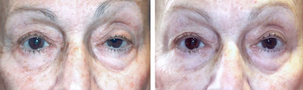 ptosis-before-after-12-1024x305