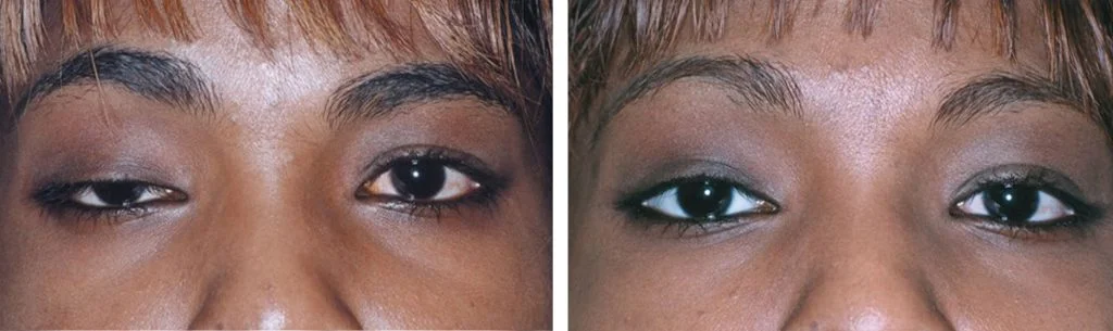 ptosis-before-after-13-1024x305