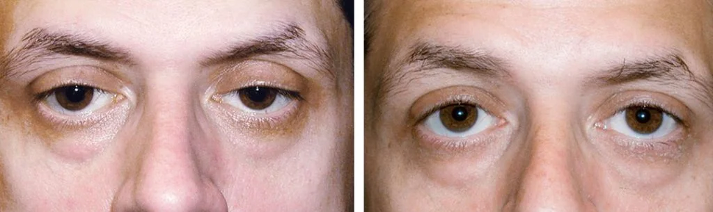 ptosis-before-after-14-1024x305