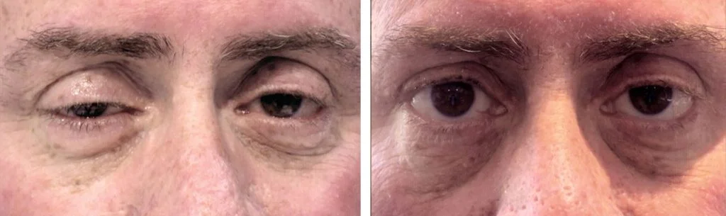 ptosis-before-after-15-1024x305