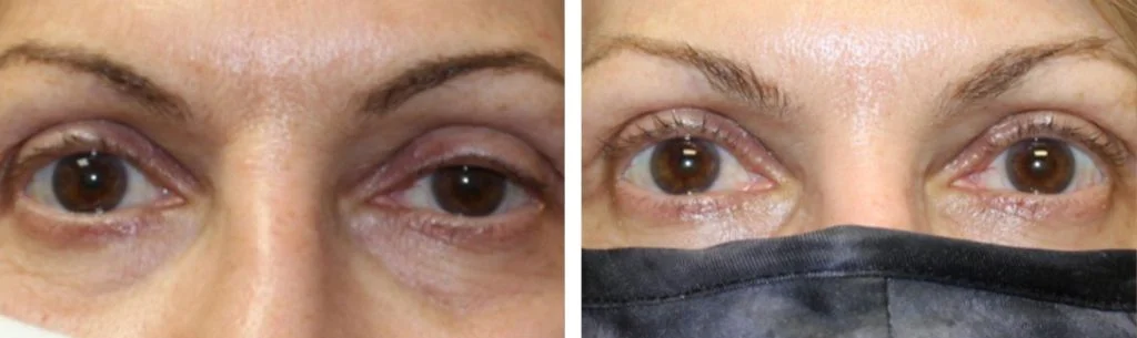 ptosis-before-after-2-1024x305