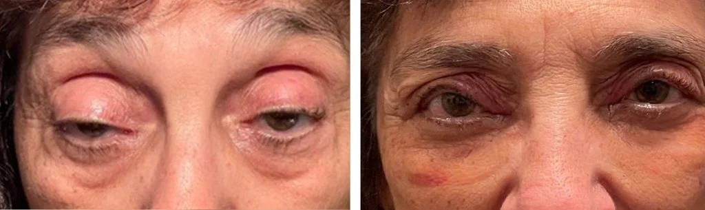 ptosis-before-after-3-1024x305