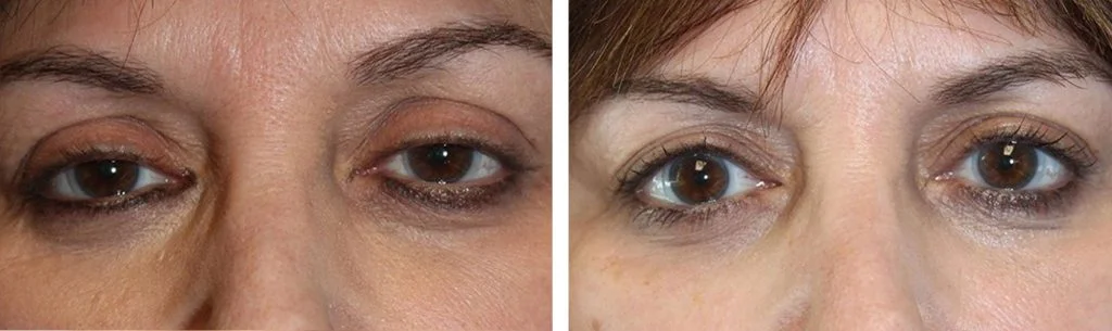 ptosis-before-after-4-1024x305