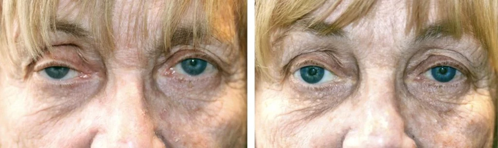 ptosis-before-after-5-1024x305