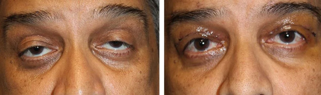 ptosis-before-after-6-1024x305