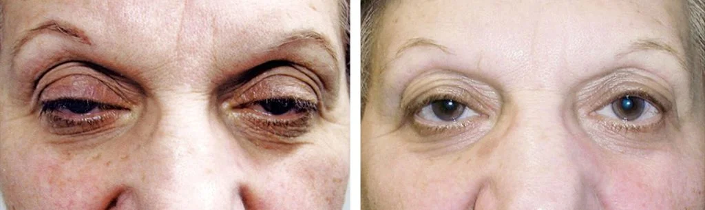 ptosis-before-after-7-1024x305
