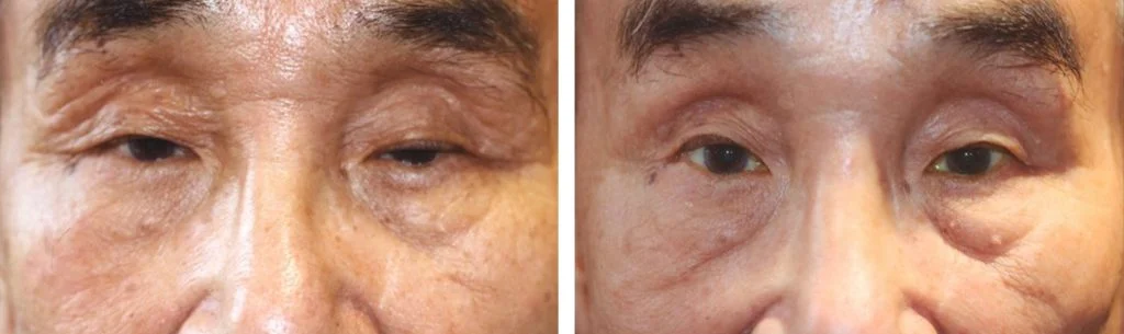 ptosis-before-after-8-1024x305