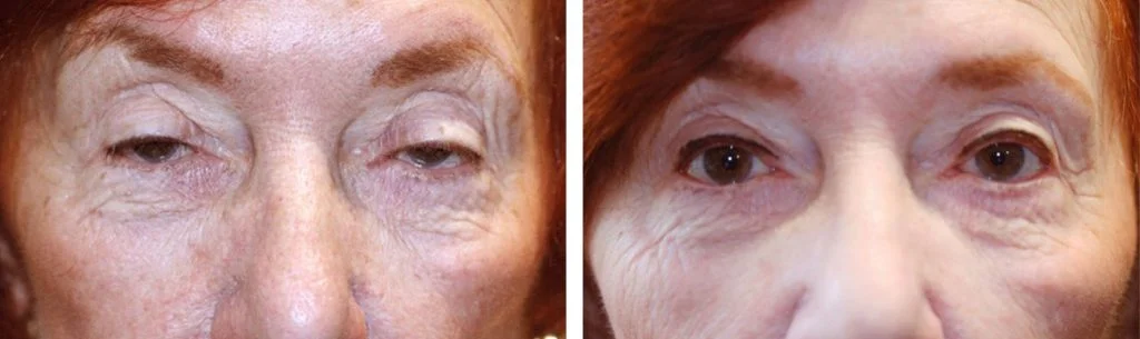 ptosis-before-after-9-1024x305