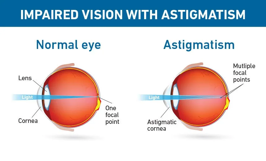 Astigmatism-2