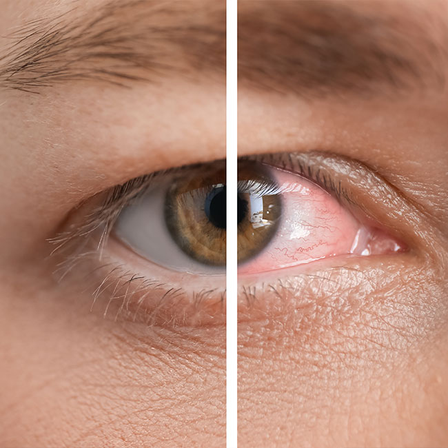 Closeup-view-of-man-before-and-after-eye-treatment