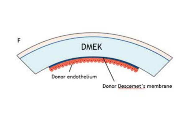 DMEK Surgery