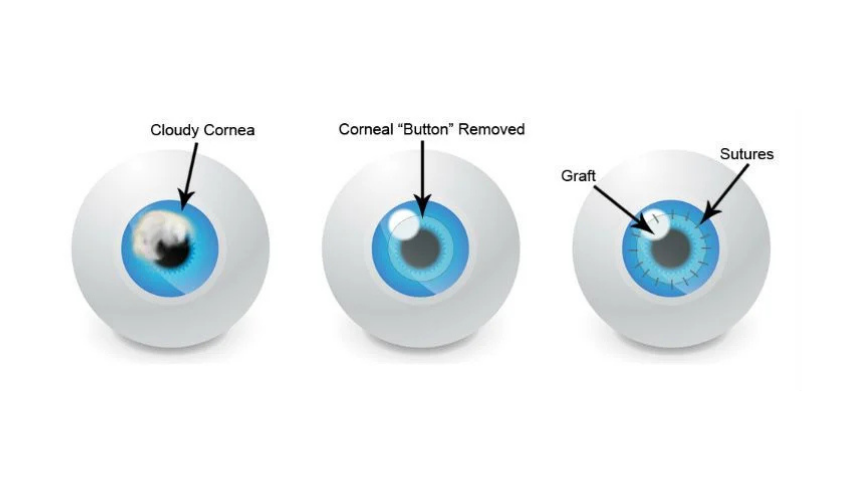 What Causes Cornea Problems