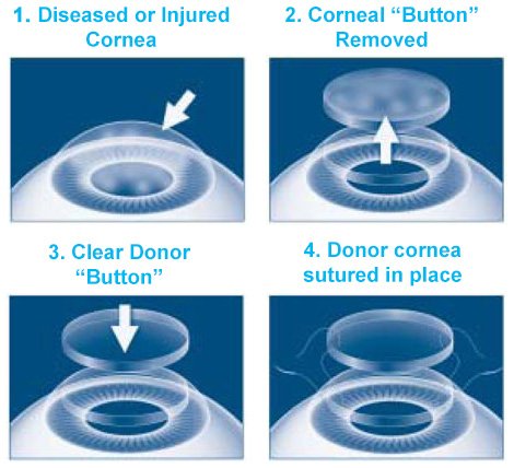 cornea-transplant-1