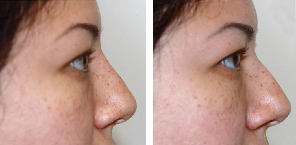 juvederm-before-after-1-1024x501