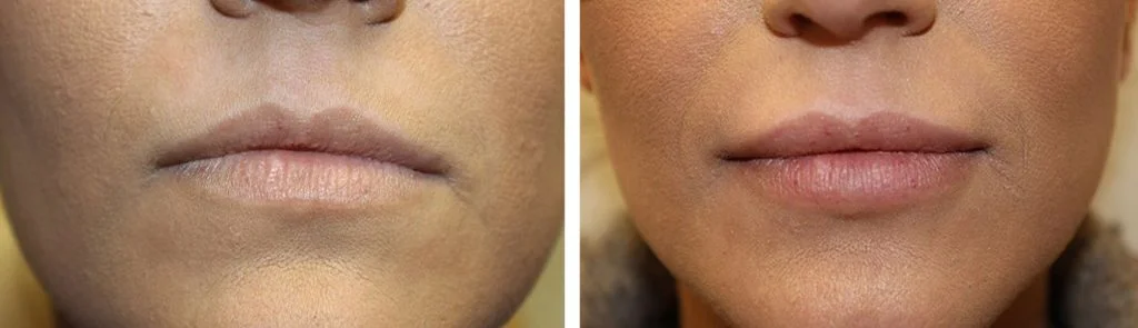 juvederm-before-after-2-1024x295