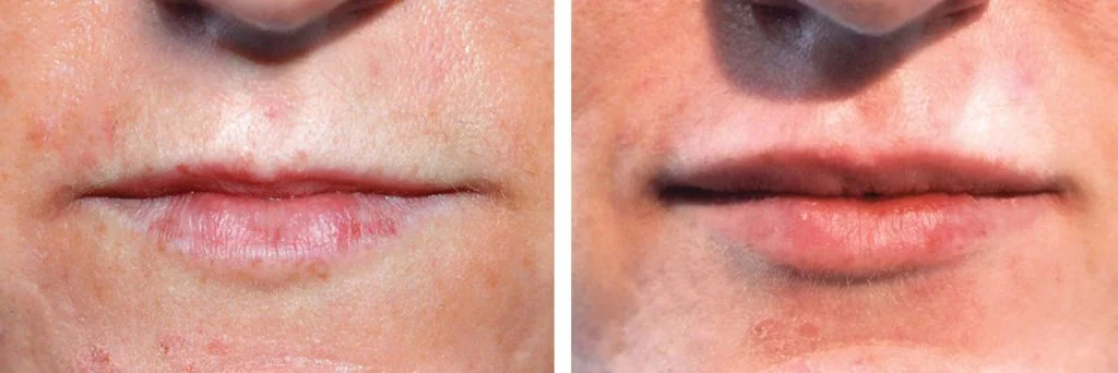 juvederm-before-after-3-1024x342
