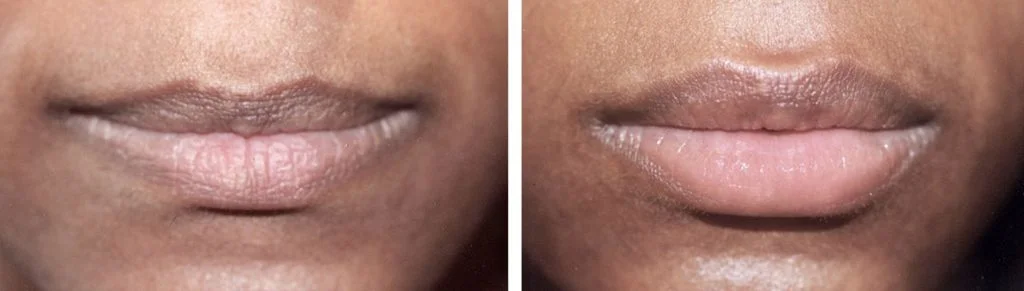 juvederm-before-after-4-1024x291