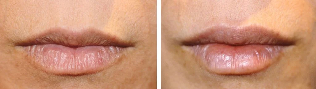 juvederm-before-after-5-1024x291