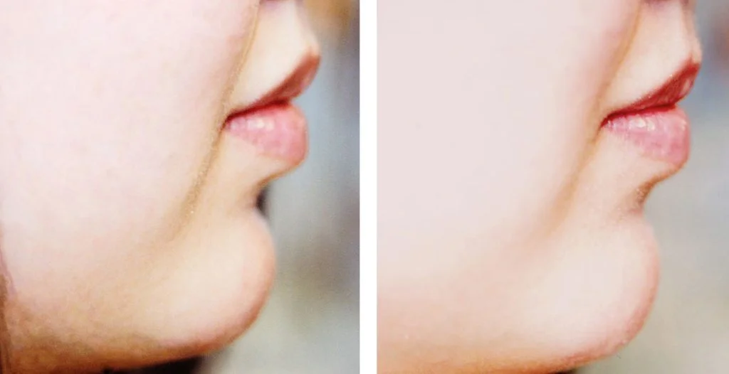 juvederm-before-after-6-1024x526