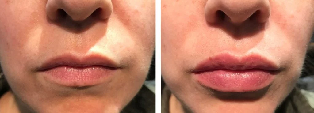 juvederm-before-after-7-1024x369