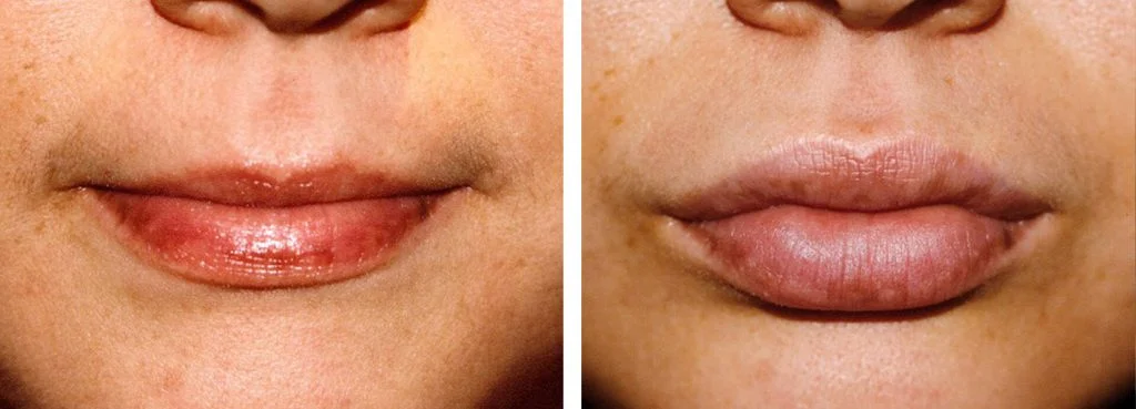 juvederm-before-after-8-1024x369