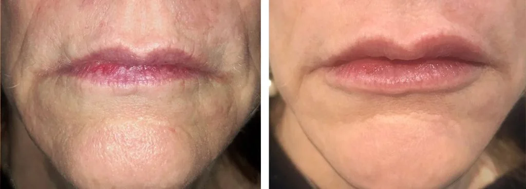 restylane-before-after-1-1024x369