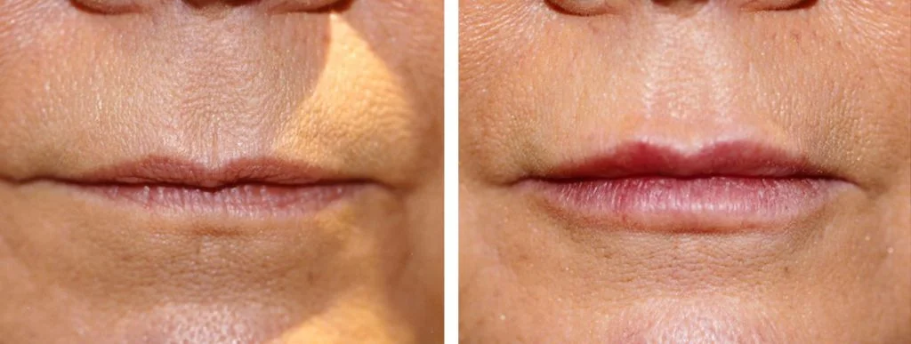 restylane-before-after-10-1024x387