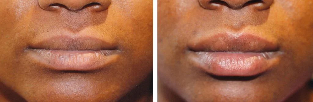 restylane-before-after-11-1024x334