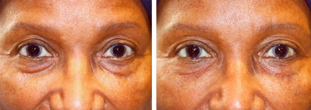 restylane-before-after-12-1024x364