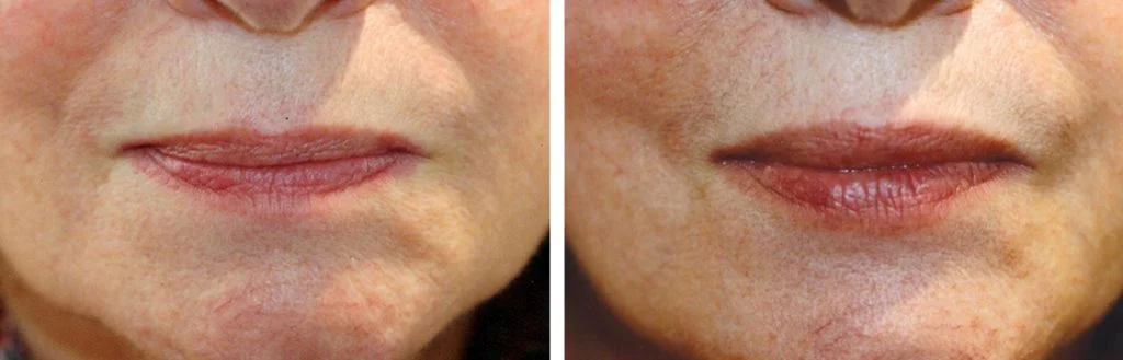 restylane-before-after-13-1024x329